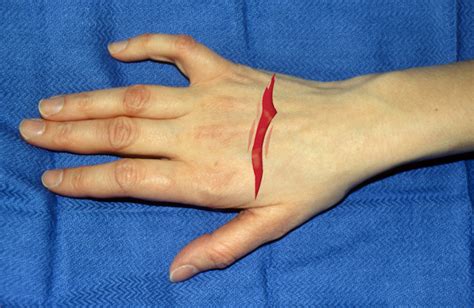 Subscribe to Codify by AAPC and get the code details in a flash. . Laceration of finger icd 10